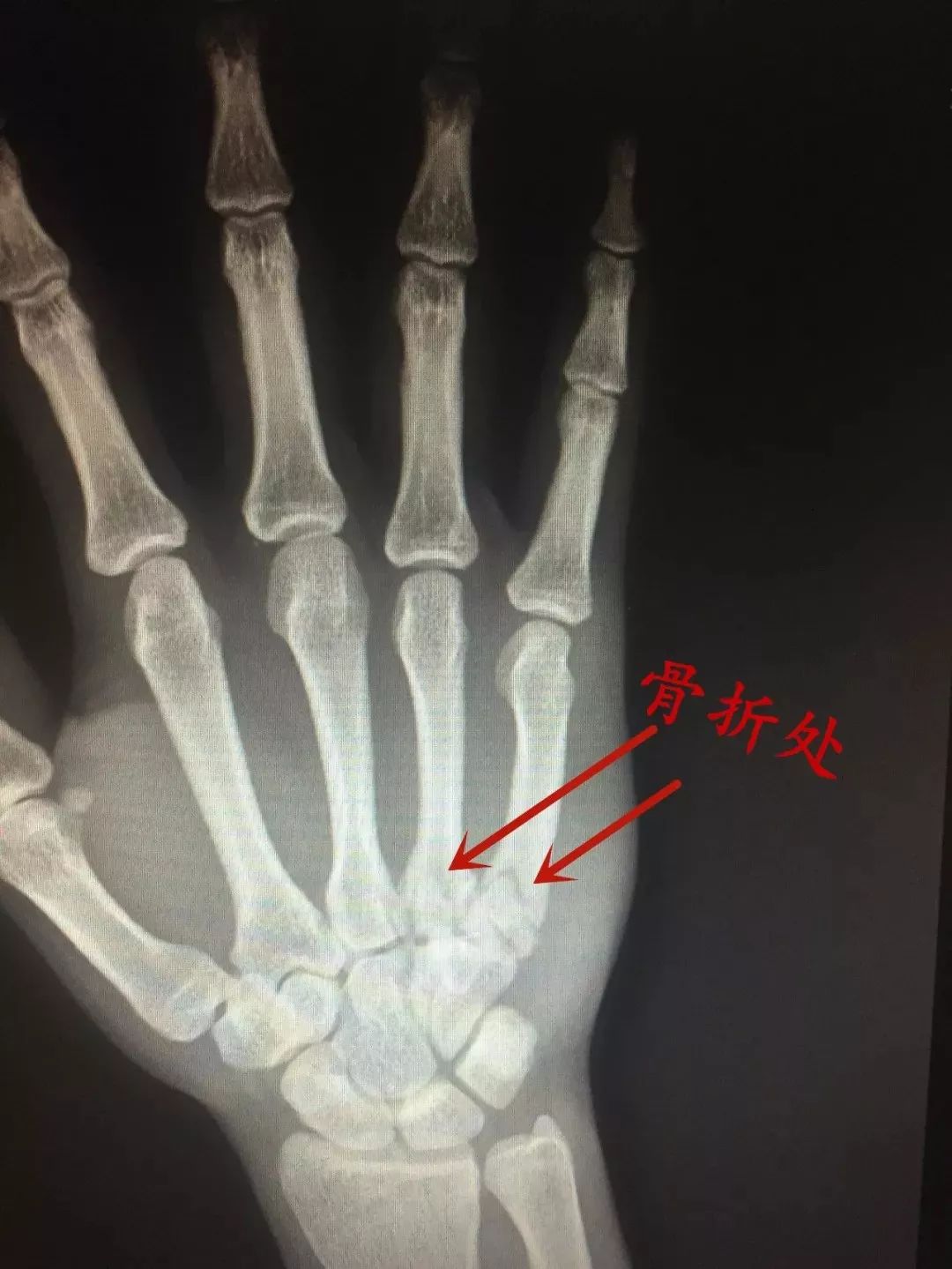 10岁男孩打拳皇致掌骨骨折，游戏与安全的边界
