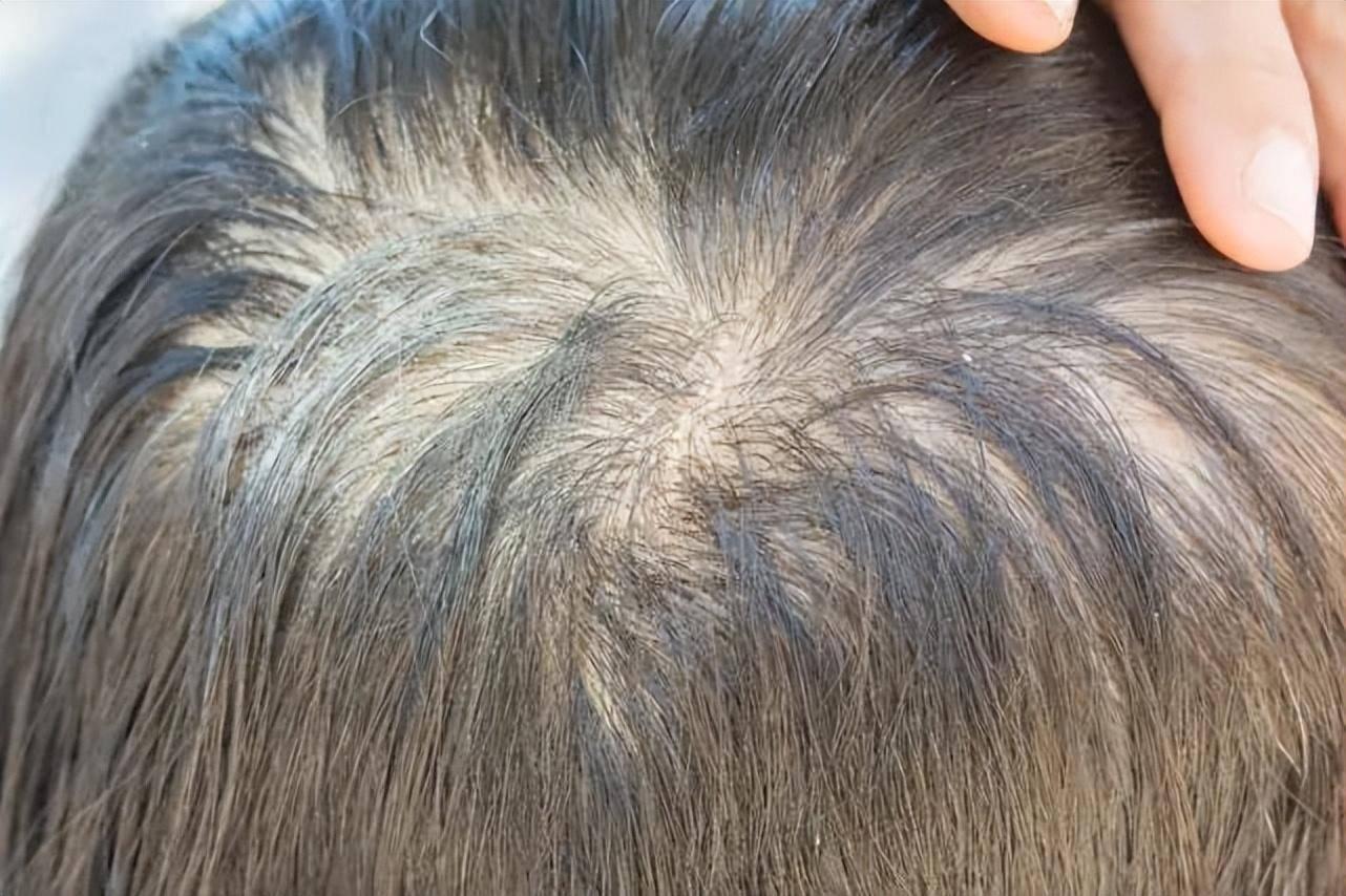 从秃头到发量王者,我用365天长头发过程视频,实践出这套生发攻略 从秃头到发量王者,我用365天长头发过程视频,实践出这套生发攻略